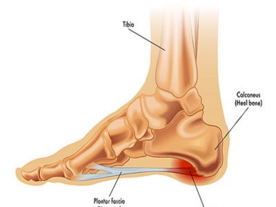 Plantar Fasciitis