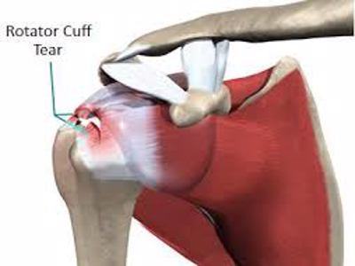  Rotator Cuff