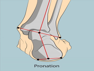 Pronated foot