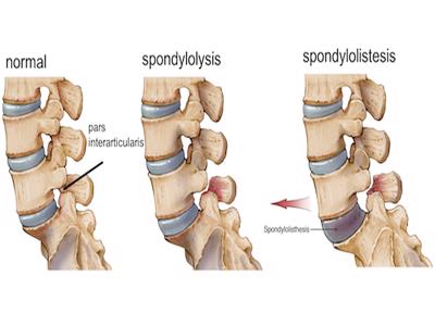 Spondylolysis & Spondylilisthesis
