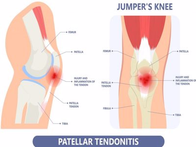 jumper's Knee