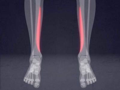 Shin Splints