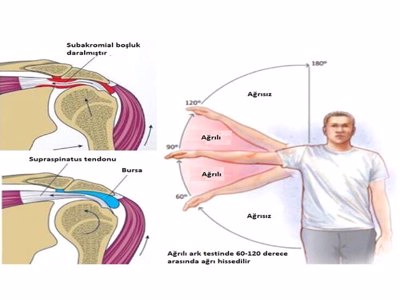 Impingement syndrome
