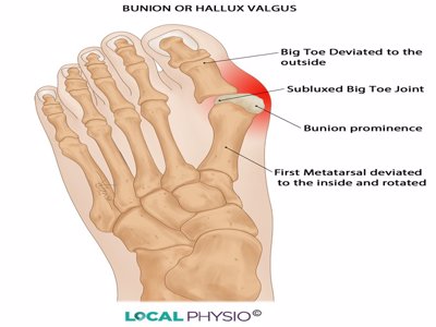 Hallux valgus