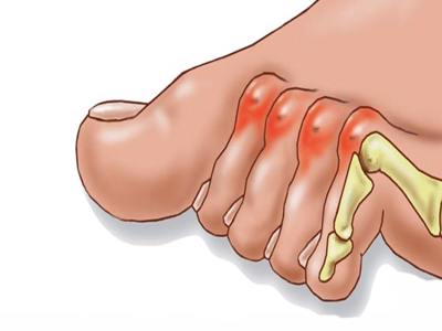 Mallet finger