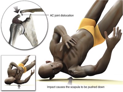 Acromioclavicular Joint Dislocation