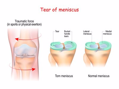 meniscus tear