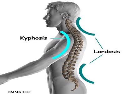 Hyperlordosis