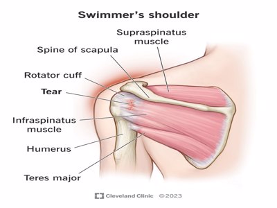 Swimmer's Shoulder