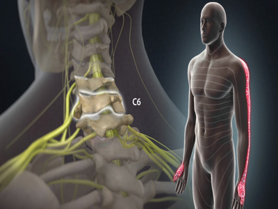 Cervical disc herniation