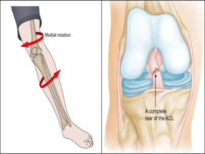 anterior cruciate ligament