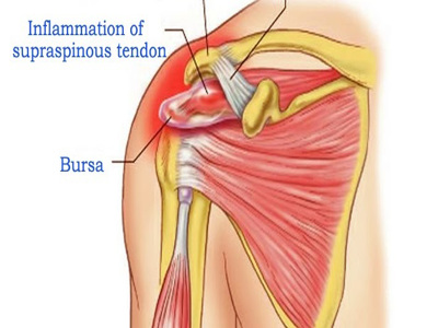 Supraspinatus Tendinitis