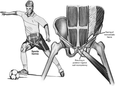 Sprtman Hernia