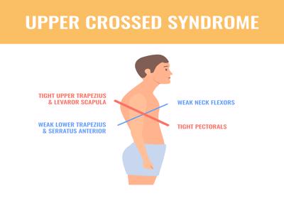 Upper Cross Syndrome