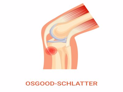 Osgood Schlatter
