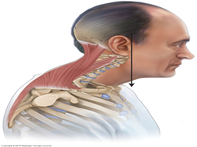 Forward Head Posture