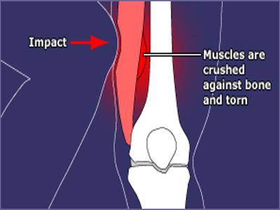 Charley Horse