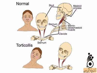 torticollis posture