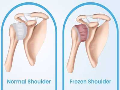 frozen shoulder
