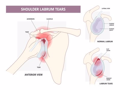 Labrum Tear